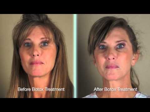 Botox para Sincinesia | Evaluación del paciente parálisis de Bell Botox for Synkinesis | Bell’s Palsy Patient Testimonial