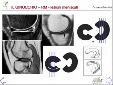 Radice elecampane con giunti Dolore sul diritto delle donne