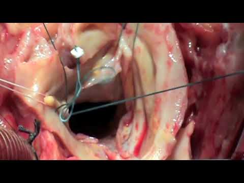 Chronic Type Ascending Aortic Dissection in Patient with Aortic Coarctation