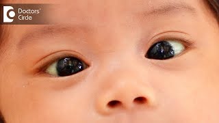 How to detect squint in kids? - Dr. Anupama Kumar