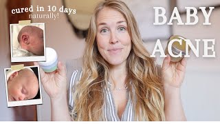 Get Rid of Baby Acne Naturally  |  Newborn Acne Cure