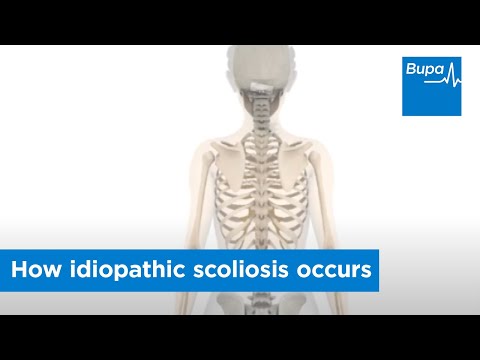 特発性脊柱管狭窄症はどのようにして起こるのか (How idiopathic scoliosis occurs)