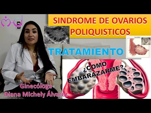 Síntomas y Tratamiento De Los Ovarios Poliquísticos