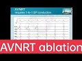 AVNRT Ablation Avnodalreentrytachycardia EPstudy Bestcardiology