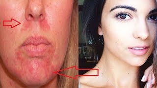 Home Remedies for Perioral Dermatitis- Get Rid Red Bumps Around the Mouth !