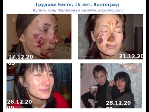 Удалить пигментное пятно отзывы Chanel сыворотка против пигментных пятен отзывы