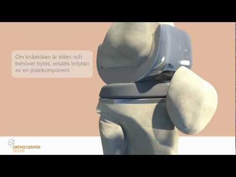 Knäledsplastik Ortho Center Skåne