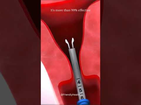 Mirena IUD for Endometriosis | Mirena IUD Experience #familyplanning #contraception #miren