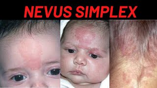 NEVUS SIMPLEX Causes, Symptoms, What is it?
