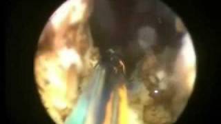 TULIP (trans uretral lase incision of the prostate)