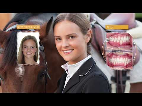 Young Patients Kids Before and After treated with the Carriere Appliance