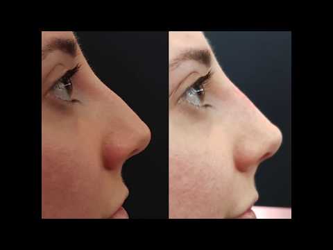 What is non-surgical nose reshaping?