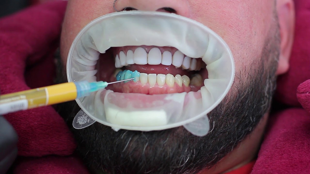 Dr. Fiorotto - Aplicação de Lentes em Resina #8 Fernandão