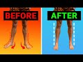 How To Fix Your Turned Out Foot Duck Feet VERY FAST Results