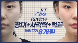 윤곽3종 8개월차 케이스리뷰 ㅣ비티성형외과