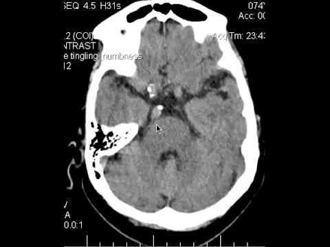 CT Head 74yoF w Facial pain w Trigeminal Impression  DISCUSSION by Radiologist