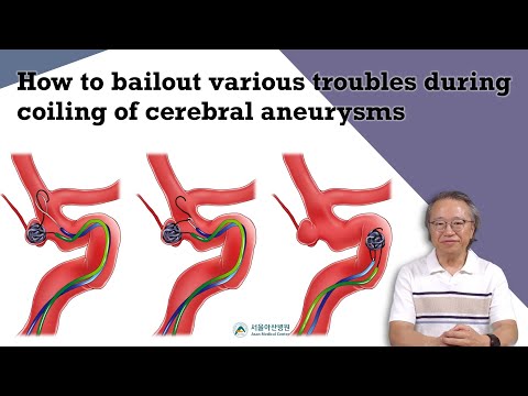 [English ver for Professionals] How to bail out difficulties during coiling of cerebral aneurysms