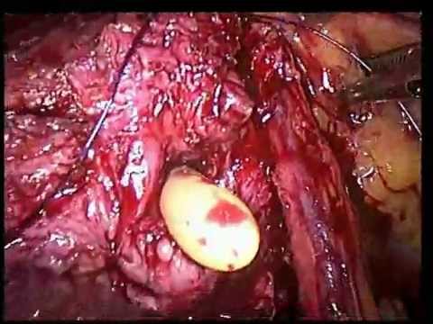 Come curare BPH rimedi popolari Il cancro alla prostata statistiche