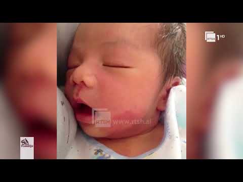 Shenjat e lindura në lëkurë, çfarë i shkakton dhe si ti trajtojmë | Si në familje