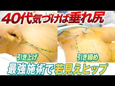 40代からの救世主！垂れ尻が若返る最強施術公開！【糸リフト】