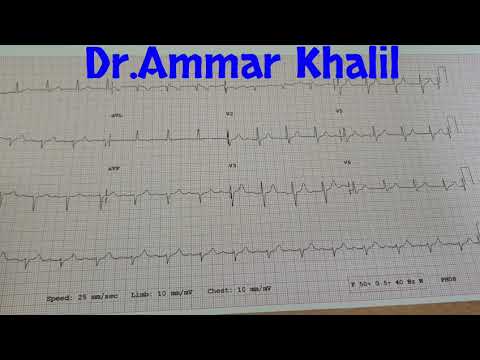 How to determine ECG Axis ?
