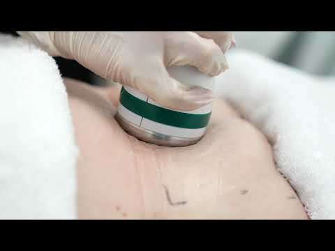 Onda Coolwaves Body Sculpting