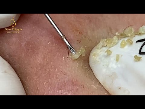 Loan Nguyen Acne Treatment (#156)
