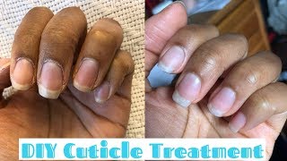 How to Fix Dry Cuticles- DIY nail treatment