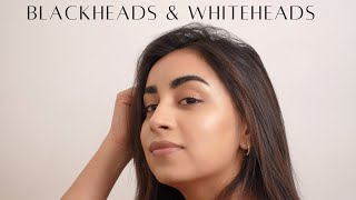 WHITEHEADS &  BLACKHEADS |DR. RIYA