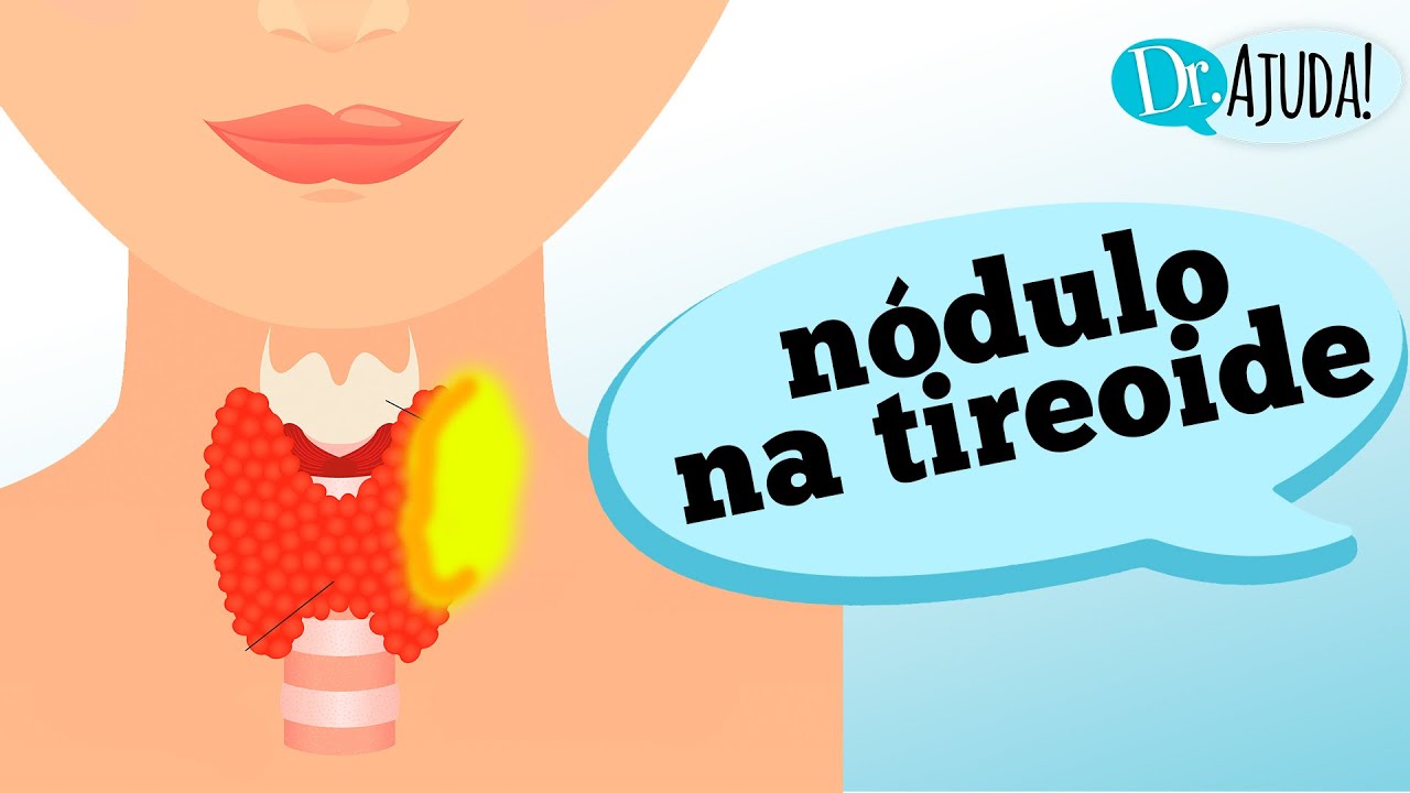 Quais os sintomas do NÓDULO NA TIREOIDE?