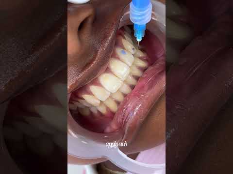 tooth gem process #toothgems #torontotoothgems