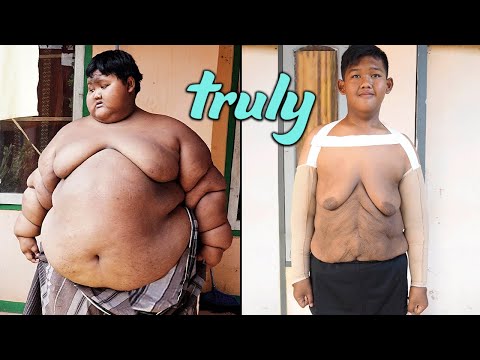 'World’s Heaviest Kid' Has Saggy Skin Surgery | TRULY