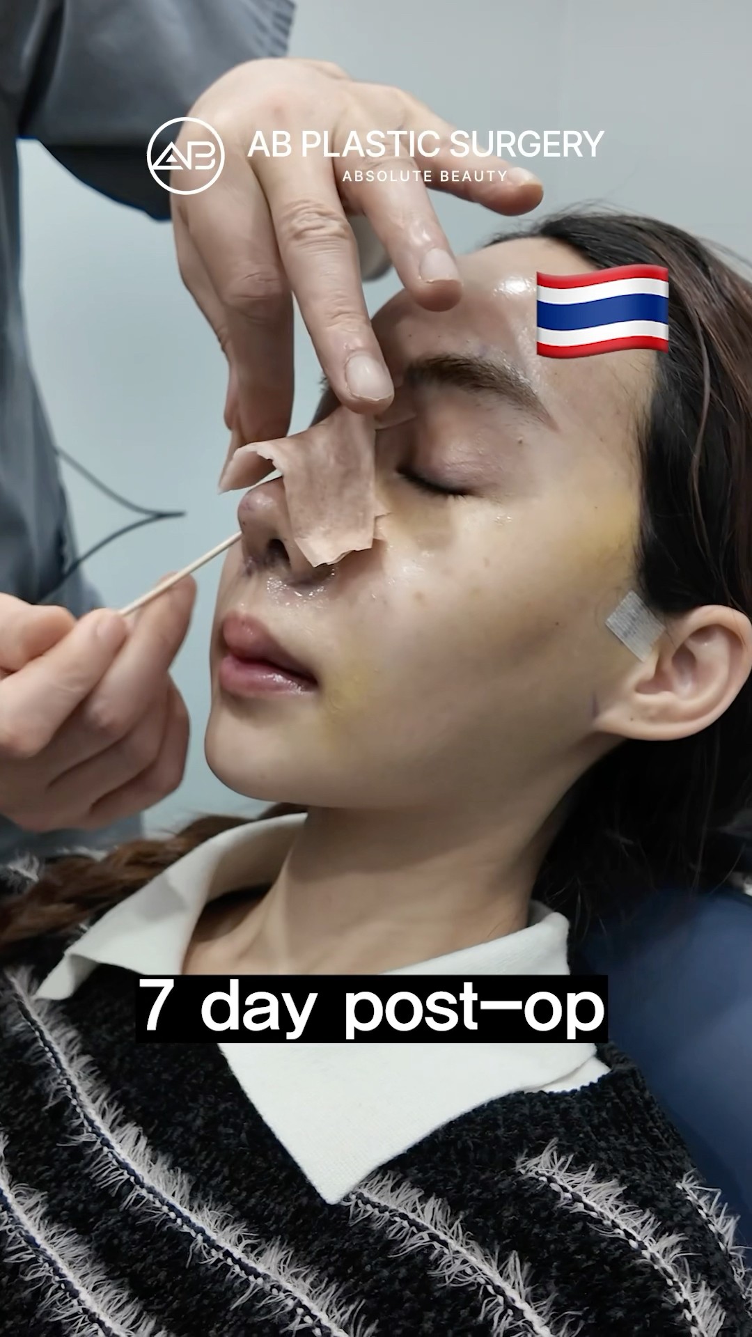 My revision nose surgery in Korea #koreanplasticsurgery