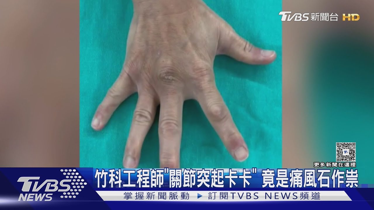 竹科男「手關節突起」影響活動 不是腫瘤是痛風石