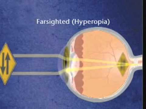 Vérszegénység myopia