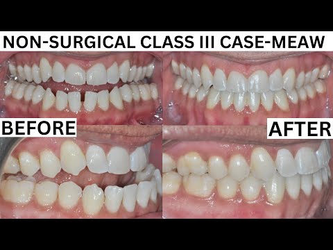 SEVERE UNDERBITE CORRECTION using the MEAW Technique-NO SURGERY-Adult Braces-Class III Open Bite Fix