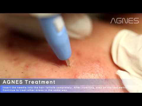 download lagu mp3 mp4 Agnes Laser Before And After, download lagu Agnes Laser Before And After gratis, unduh video klip Agnes Laser Before And After