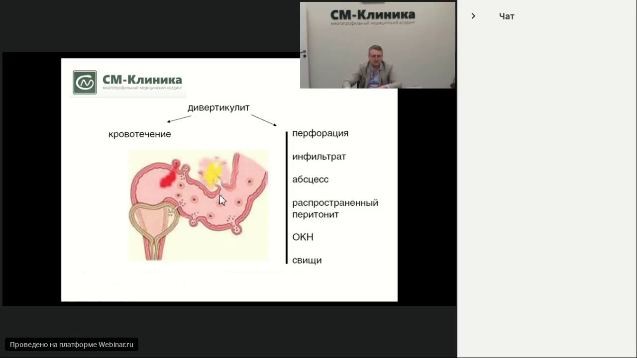 Запись вебинара «Дивертикулез толстой кишки» - Пересада И.В. (08.05.2018)