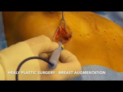 Breast Augmentation Honolulu Hawaii - Healy Plastic Surgery Video