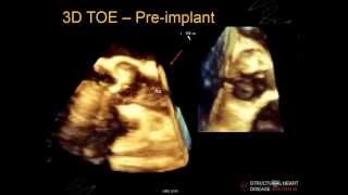 A/Prof Greg Scalia: Imaging during transcatheter aortic valve implantation