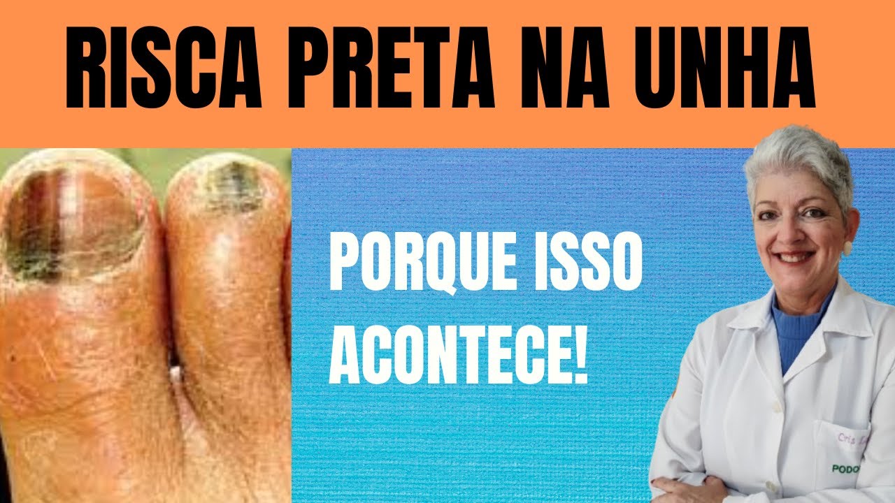 RISCA PRETA na Unha Porque isso acontece