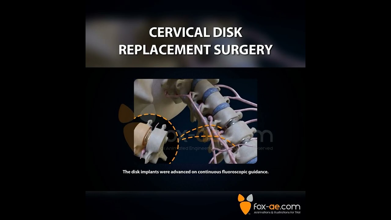 Cervical Disk Replacement Surgery