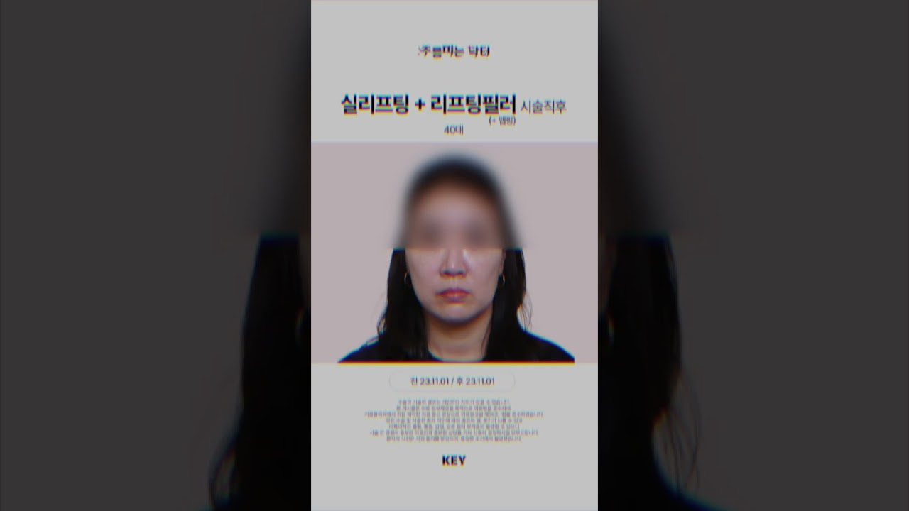 40대 실리프팅 대구키성형외과