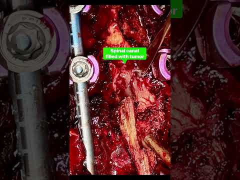 D5 Spine Tumor Surgery Success
