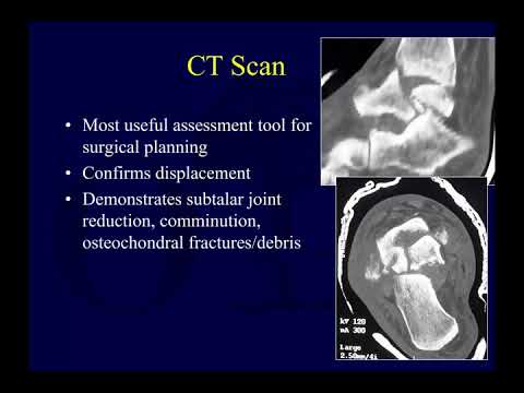 Talus fractures 1 - assessment  (OTA lecture series III l14a)