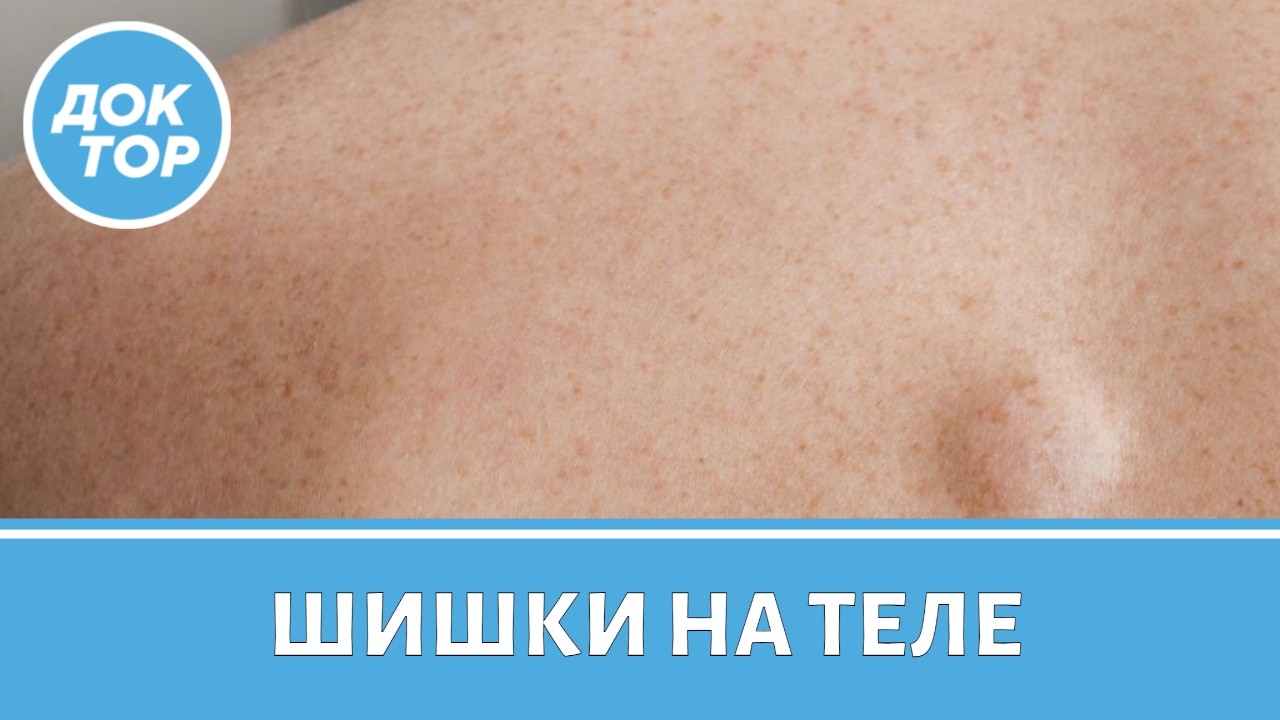 Жировик или опасная опухоль? Как отличить воспаление от чего-то серьезного