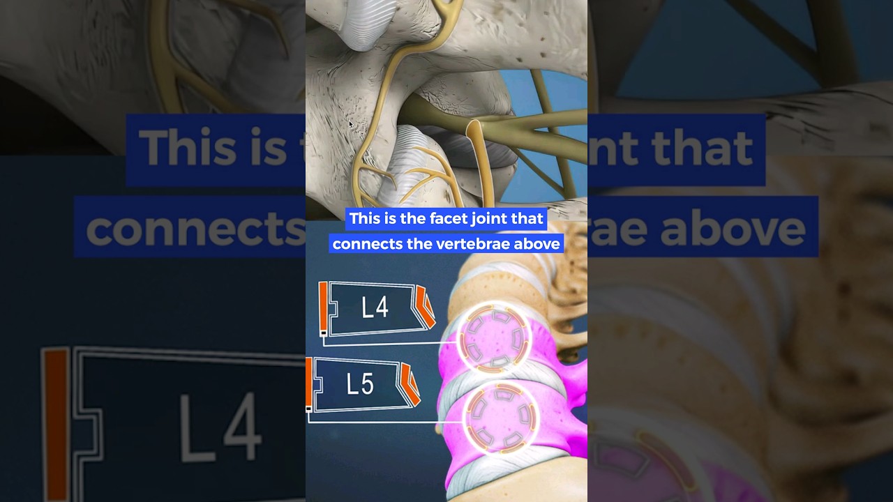 What is a Pedicle fracture?