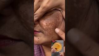 Clean Dark Spots &amp; Pigmentation Naturally At Home | Get Glowing Skin &amp; Remove Tanning #ytshorts