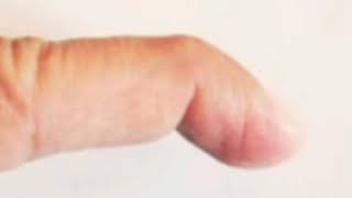 Cómo cambiar una férula de Stack de forma segura en el dedo en martillo