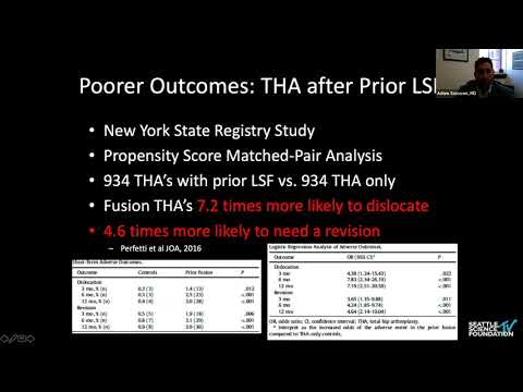 Order of Operations: Total Hip Arthroplasty and Spinal Fusion   Adam A. Sassoon, MD, MS
